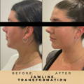 Jaw Fillers Wilmslow Before & After Dr Sknn