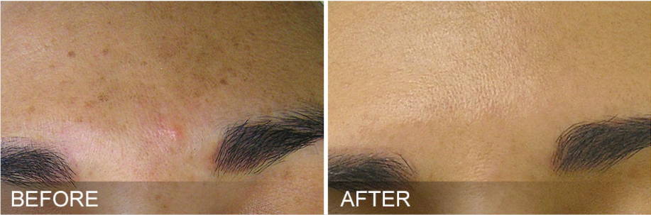 Dr Sknn Hydrafacial Before & After Picture