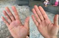  before and after natural remedy for psoriasis.