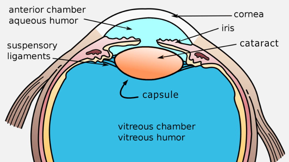 Where the cataract is within the eye