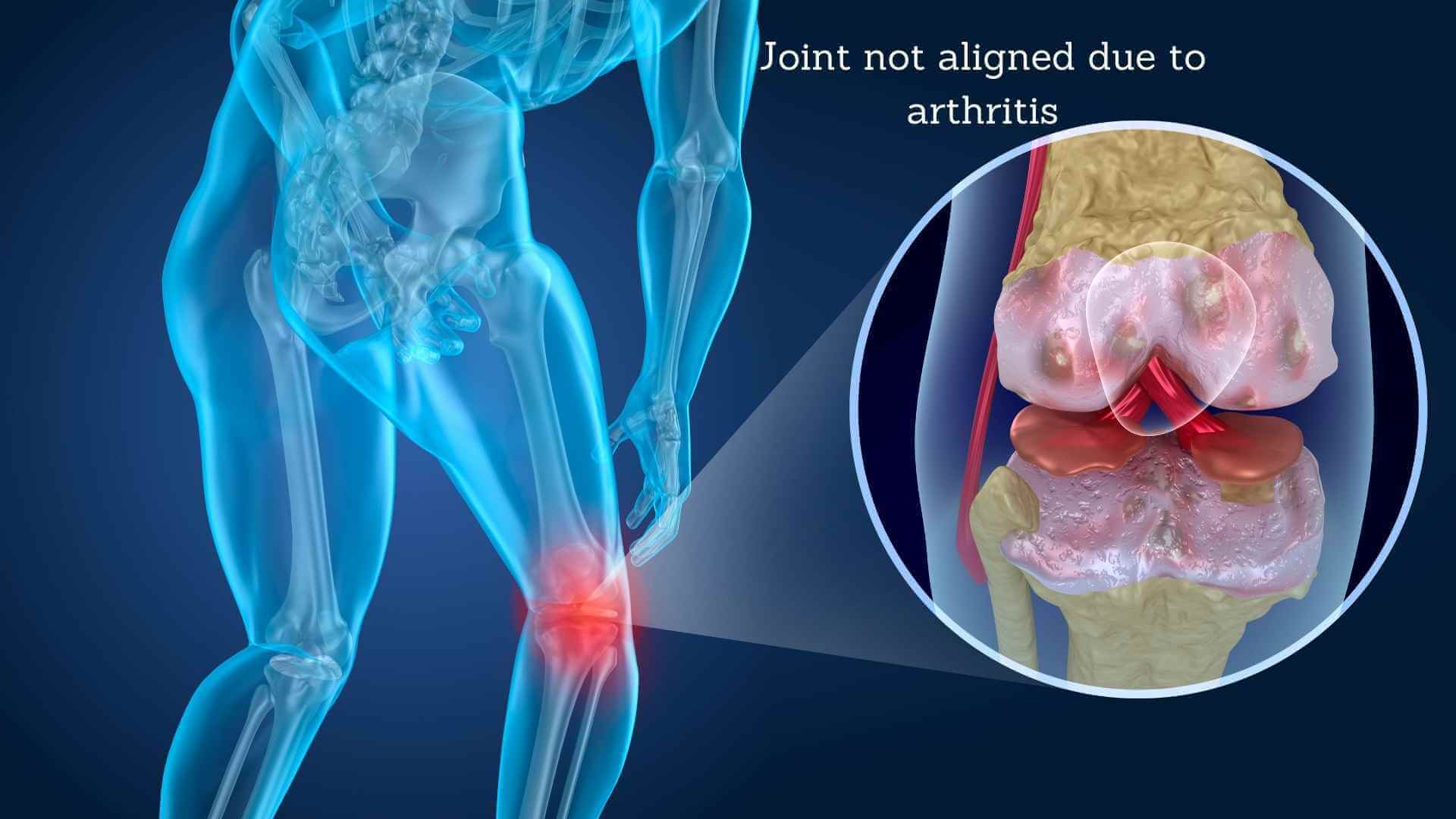 knee joint misaligned due to arthritis condition