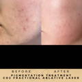 Pigmentation Treatment Co2 Fractional Laser Wilmslow Dr Sknn Before & After Picture