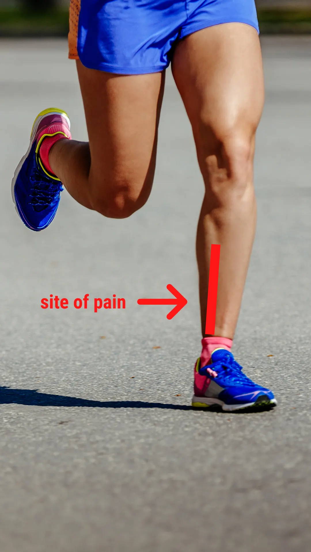 Shin splints