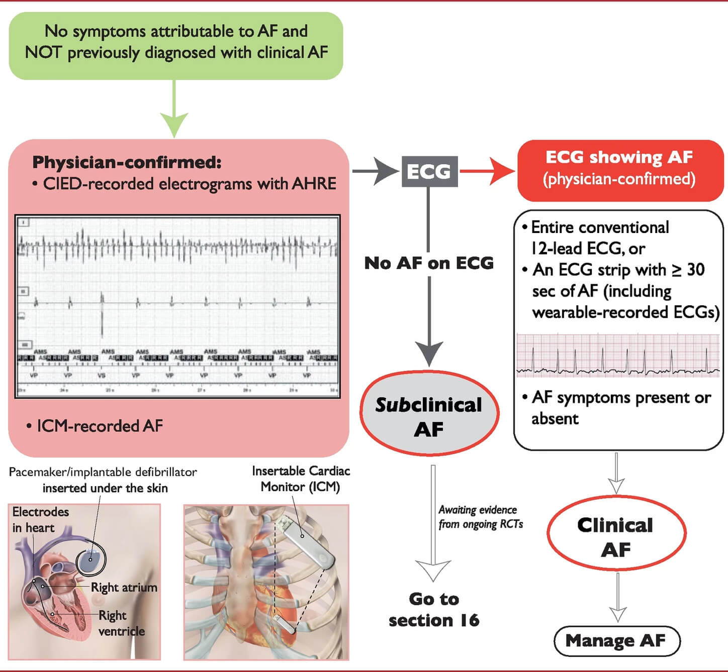 مسجل ECG لـ AFib