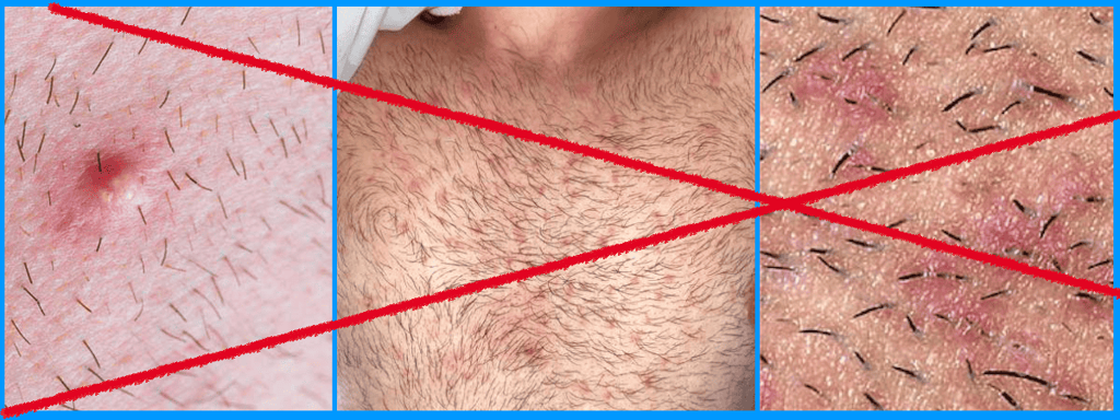 Eingewachsene Haare ohne Rasierstein