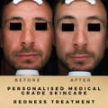 Before & After Pictures Dr Sknn Wilmslow Cheshire