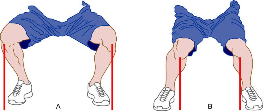 Normal knee alignment in the squat
