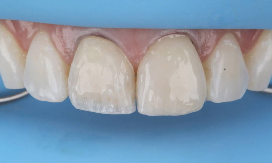 teeth undergoing restoration
