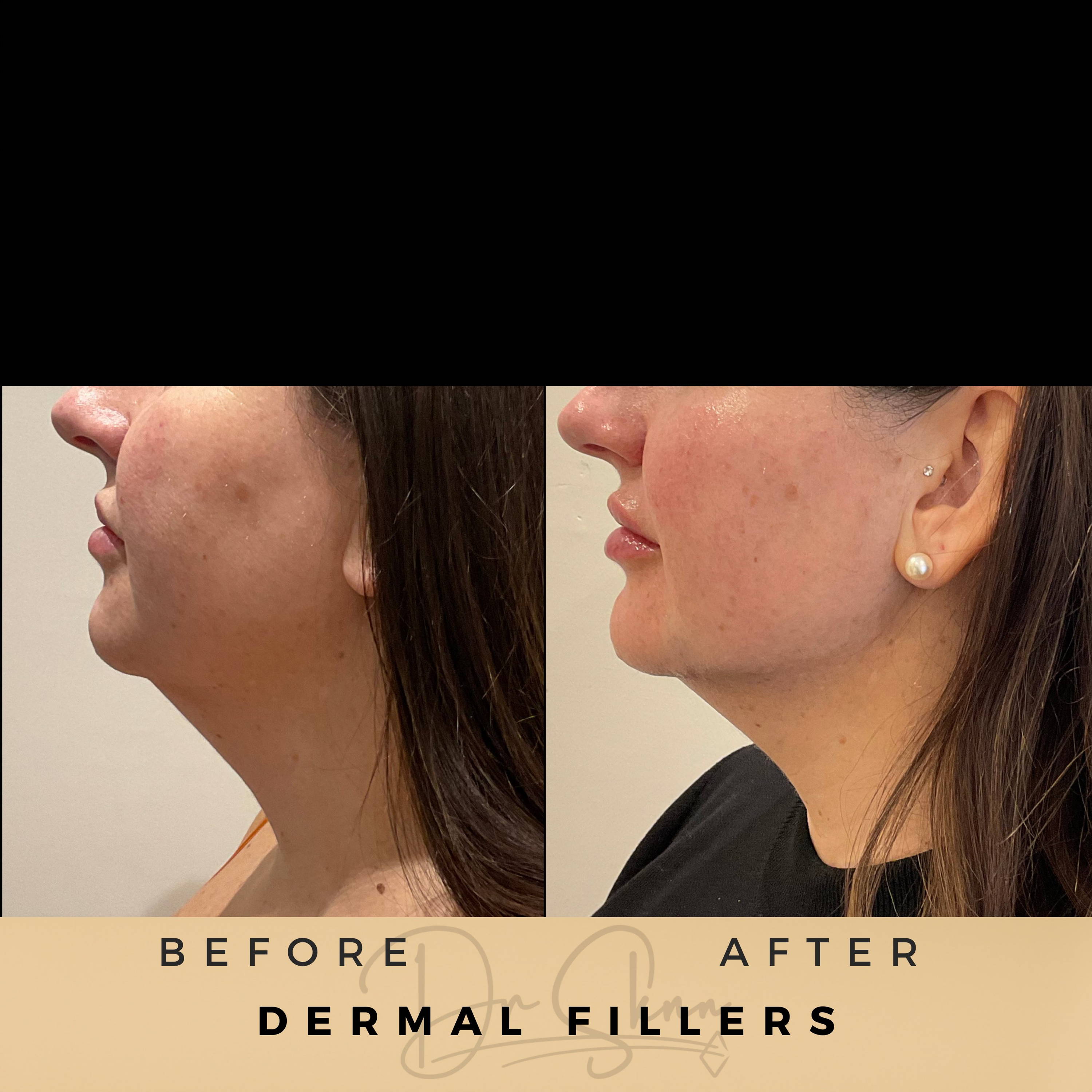 Dermal Fillers Wilmslow