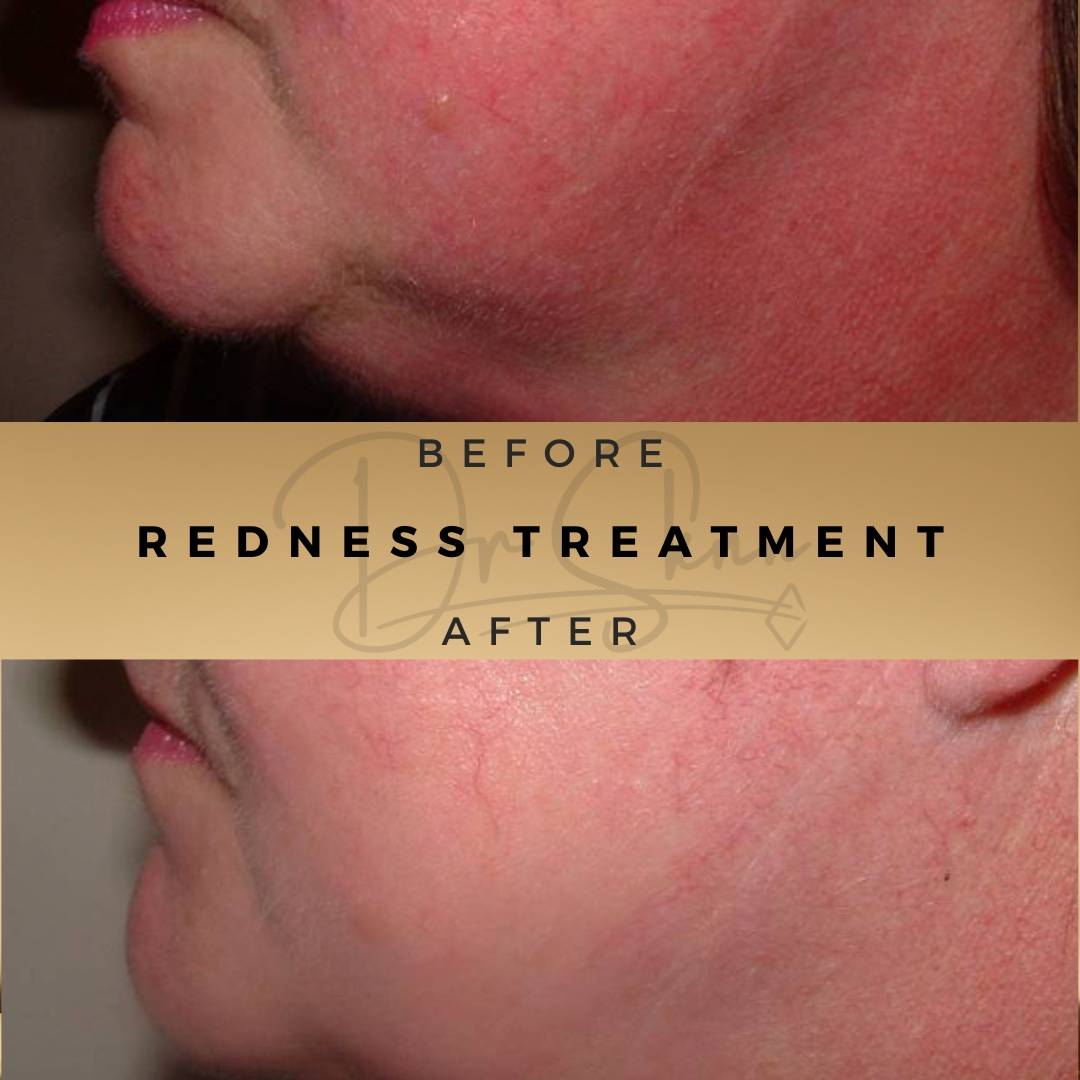 Redness Treatment Wilmslow Before & After Dr Sknn