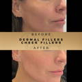 Cheek Fillers Wilmslow