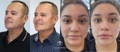 Facial balancing results achieved at California Cosmetics