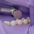 Purple polisher approaching tooth
