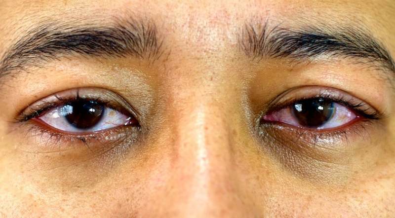Is A Swollen Eyelid After PRK Normal? (And How to Treat)