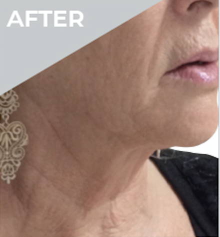 Dr Sknn Non-Surgical Face & Neck Lift After