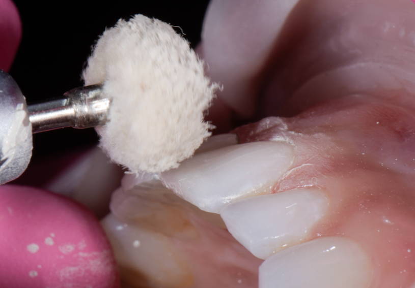 Cotton polisher polishing teeth