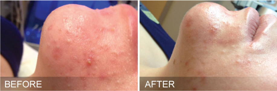 Dr Sknn Hydrafacial Before & After Picture
