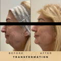 Cheek Fillers Wilmslow