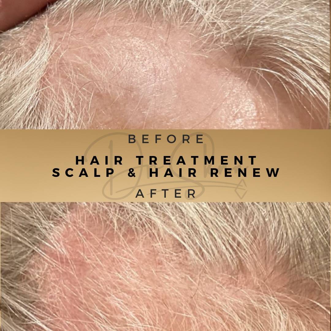 hair loss treatment / hair regrowth