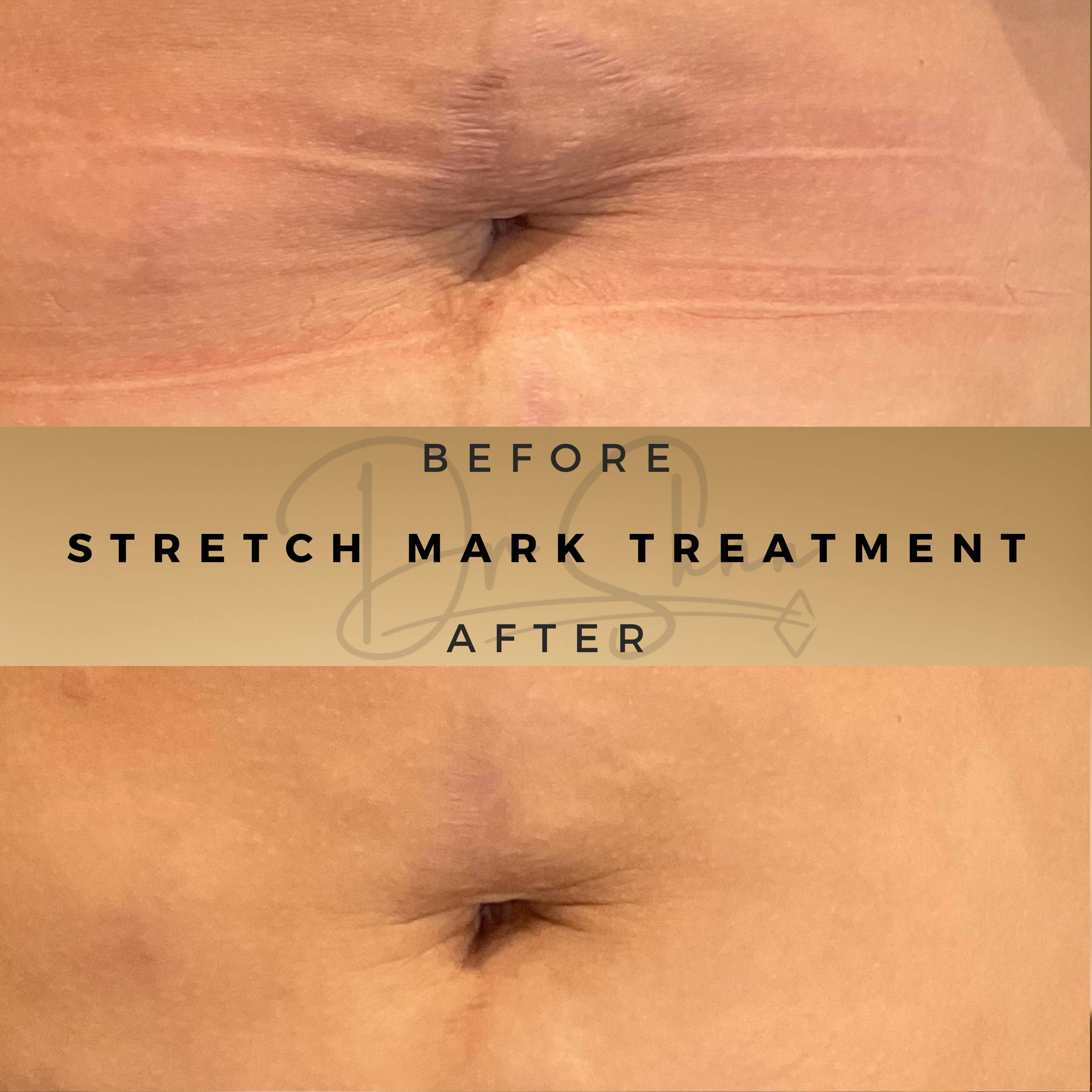 Stretch Mark Treatment Wilmslow Before & After Dr Sknn