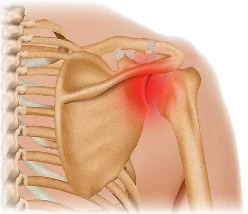 Rotator Cuff Injury Illustration