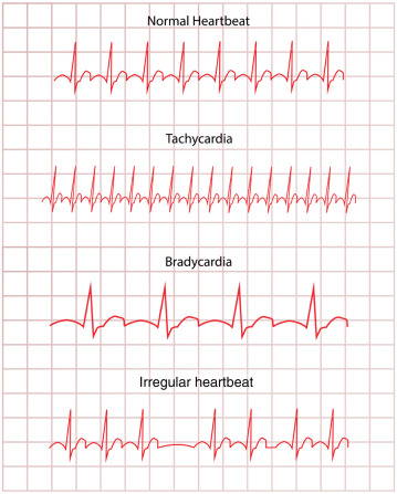 تفسير بطء القلب ECG