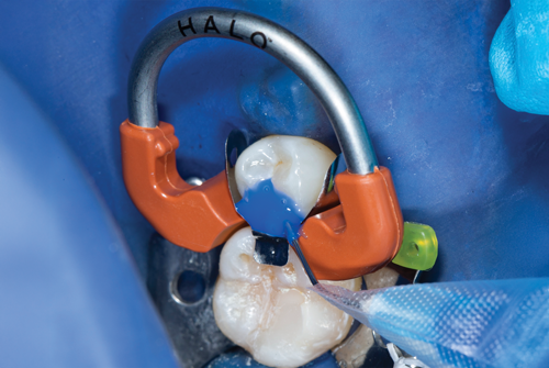 syringe applying etchant to tooth