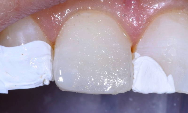 tooth after restauration with composite