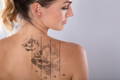 Simply You Med Spa Laser Tattoo Removal