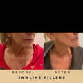 Jaw Fillers Wilmslow Before & After Dr Sknn