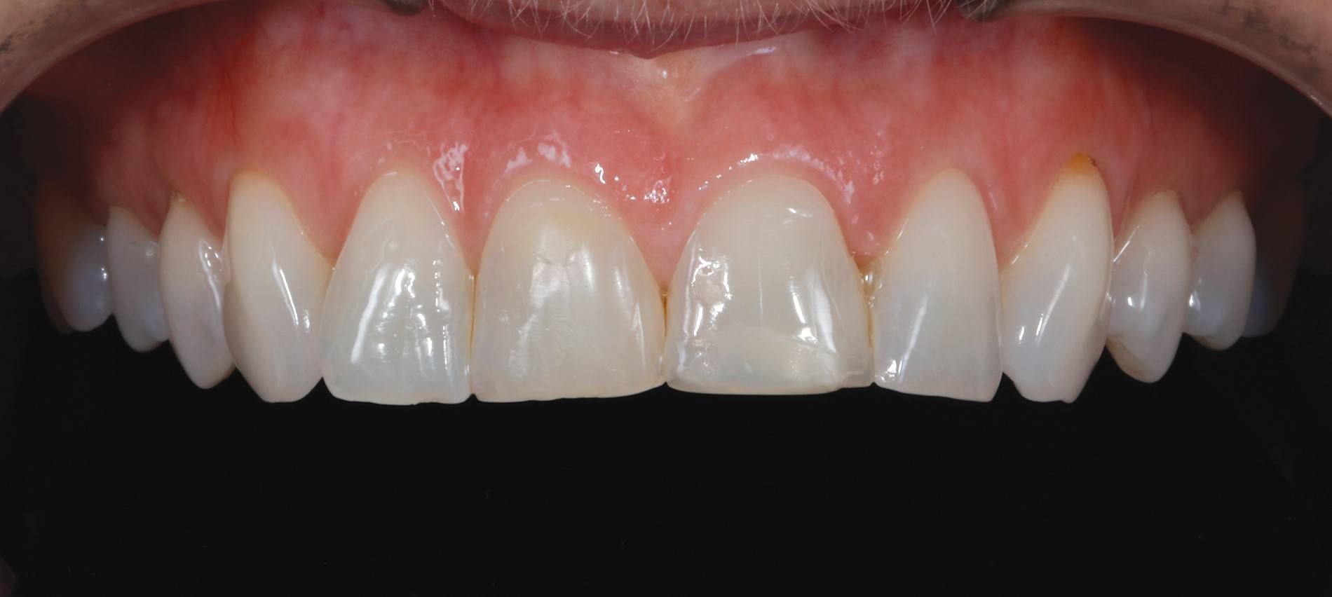 Upper teeth before procedure