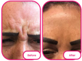 the forehead before and after taking the best collagen gummies from reviews 
