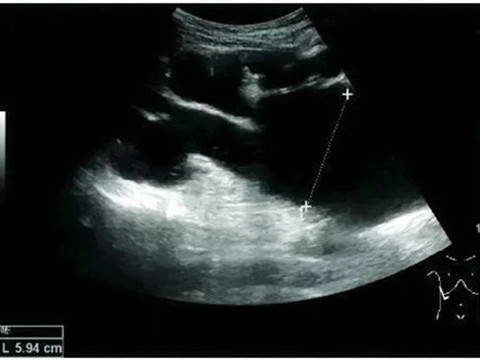 Late hydronephrosis with cortical thinning, scanned by EagleView portable ultrasound
