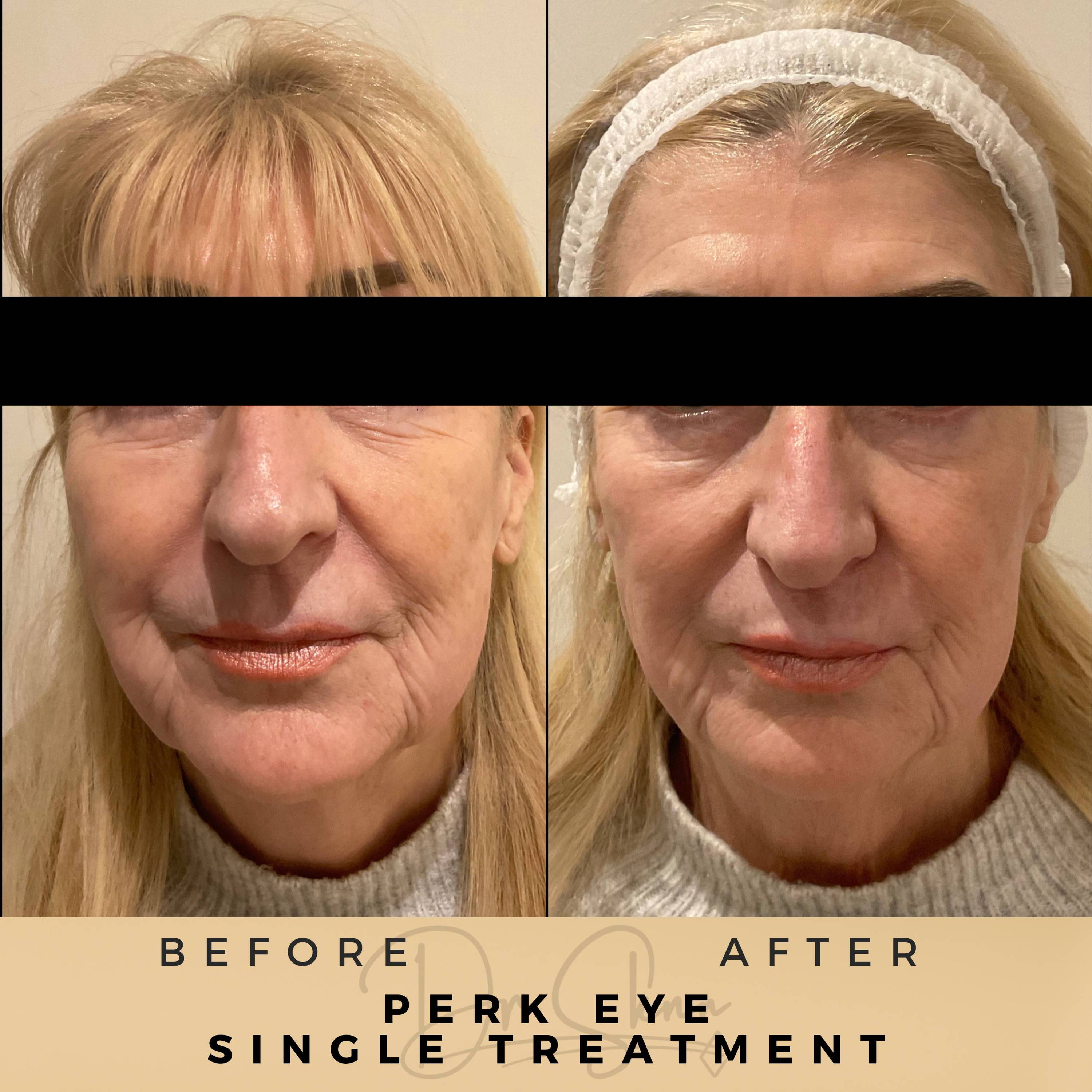 Under Eye Treatment - Dr Sknn before and after