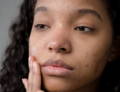 woman looking at acne scars on skin