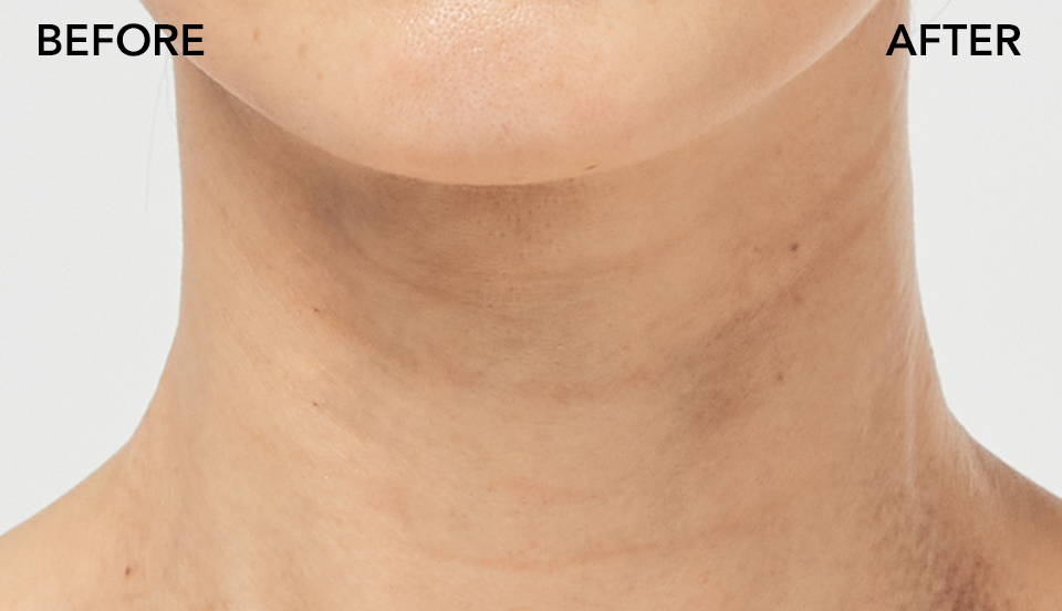 Neck Wrinkles before wrinkle patch
