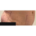ONDA - Non-surgical Skin Tightening / Fat Reduction - Three Area - Before