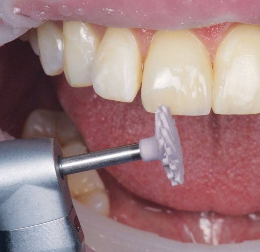 Lilac polisher approaching restored tooth