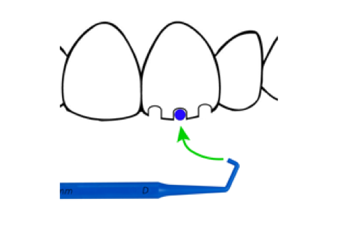 using prepsure for anterior crowns