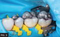 The Bioclear Method - Step 2: pre-wedged tooth