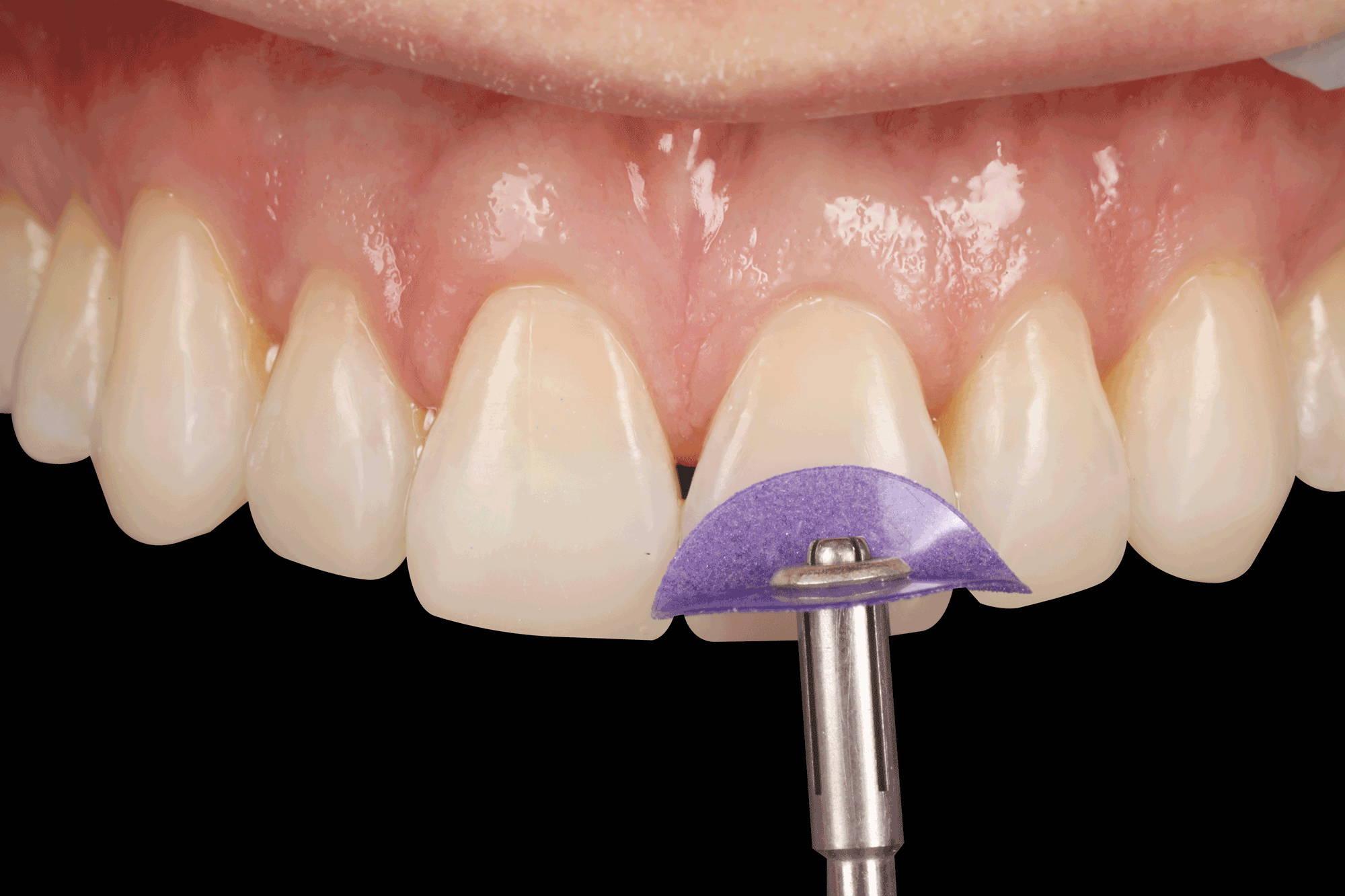 purple polisher polishing central incisor