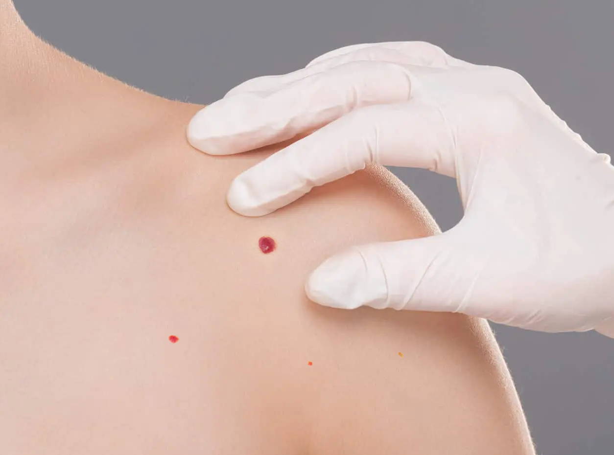 Skintify™ Remover Pen for Cherry Angiomas