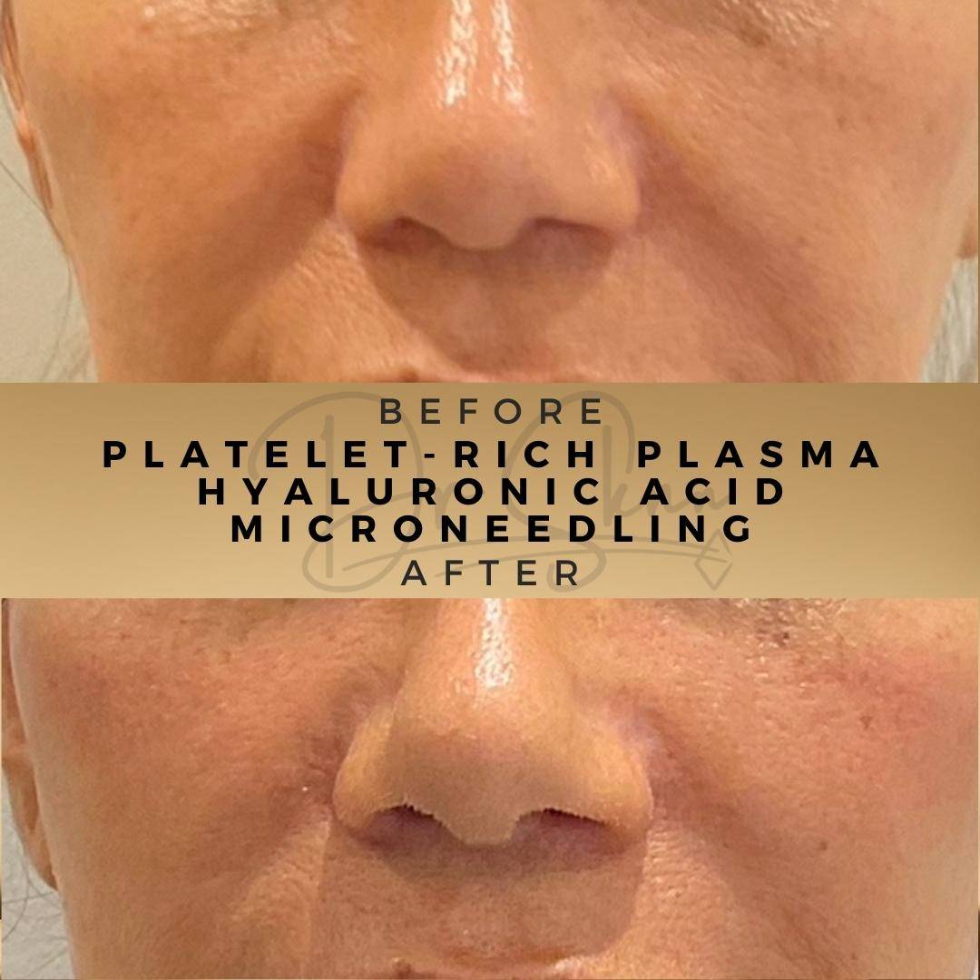 PRP Microneedling Wilmslow Before & After Dr Sknn