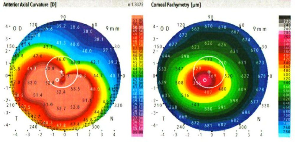 Cornea maps for stage 3 of keratoconus