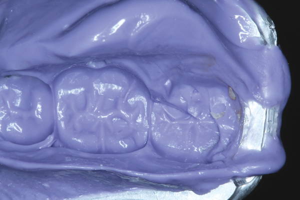 Impression of fractured crown in purple matrix material