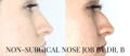 non-surgical nose job results by California Cosmetics