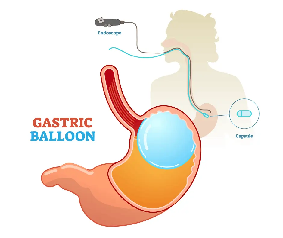 Gastric Balloon Bariatric Surgery & Weight loss in dubai
