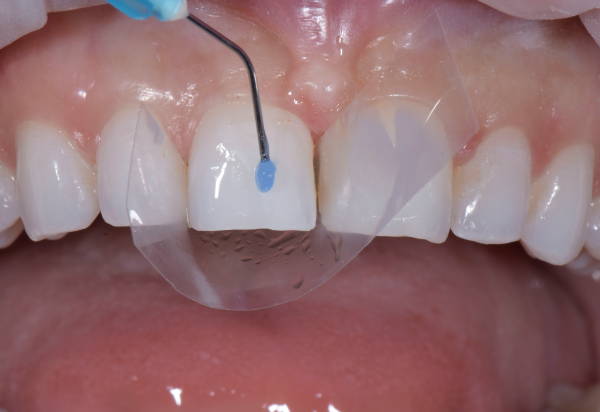 Anterior upper tooth having etch applied to it