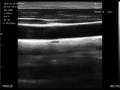 Ultraschallbild von Karotis & Schilddrüse