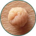 skin tag